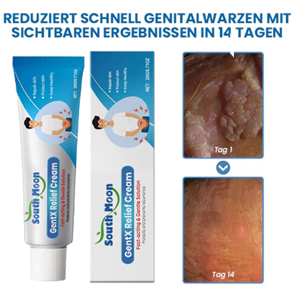 Oveallgo-SouthMoon® HPV-Creme zur Linderung genitaler Warzen