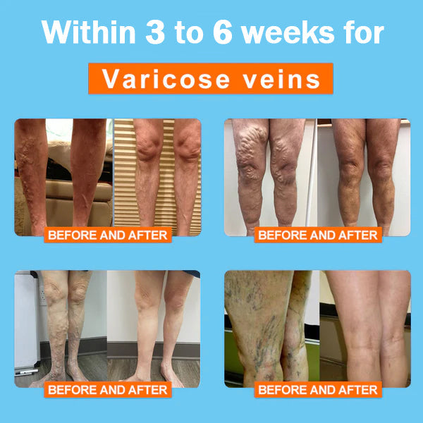 Made In USA CC™ Ionic Correction Lymphatic Detoxification Long Tube Silk Stockings(limited time offer, lasts 30 minutes)