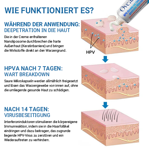 Oveallgo-SouthMoon® HPV-Creme zur Linderung genitaler Warzen