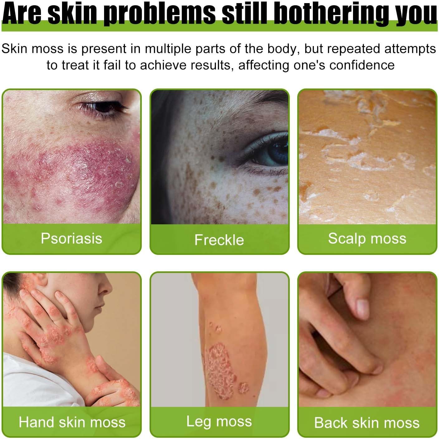 Todahof Bee Venom Psoriasis Treatment Cream, Todahof Bee Venom Psoriasis Treatment Cream, Todahof Bee Venom Cream, Psoriasis Cream, Bee Venom Psoriasis Treatment Cream (3 Pieces)