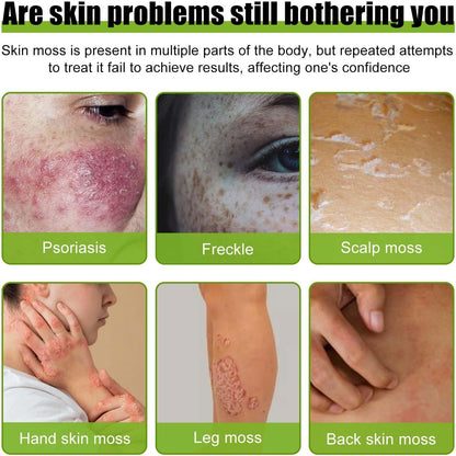 Todahof Bee Venom Psoriasis Treatment Cream, Todahof Bee Venom Psoriasis Treatment Cream, Todahof Bee Venom Cream, Psoriasis Cream, Bee Venom Psoriasis Treatment Cream (3 Pieces)