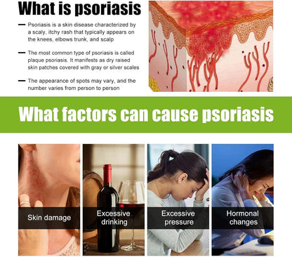 Todahof Bienengift Psoriasis Behandlungscreme, Todahof Bienengift Psoriasis Behandlungscreme, Todahof Bienengift Creme, Psoriasis Creme, Bienengift Psoriasis Behandlungscreme (3 Stück)