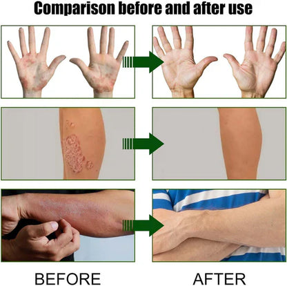 Todahof Bienengift Psoriasis Behandlungscreme, Todahof Bienengift Psoriasis Behandlungscreme, Todahof Bienengift Creme, Psoriasis Creme, Bienengift Psoriasis Behandlungscreme (3 Stück)