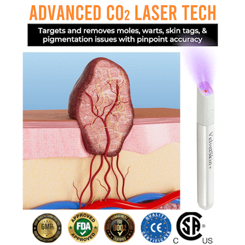 lunacipher® VelvetSkin+ All-in-One Laser Eraser Pen(Powered by CO₂ laser technology – effectively removes moles, warts, skin tags, pigmentation spots, and other skin imperfections)