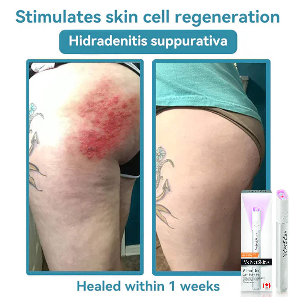 lunacipher® VelvetSkin+ All-in-One Laser Eraser Pen(Powered by CO₂ laser technology – effectively removes moles, warts, skin tags, pigmentation spots, and other skin imperfections)